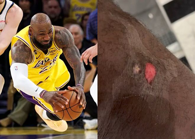 詹姆斯晒伤口喊疼!调侃今年救球到此结束 祝贺东契奇当选周最佳 詹姆斯晒伤口喊疼!调侃今年救球到此结束 祝贺东契奇当选周最佳