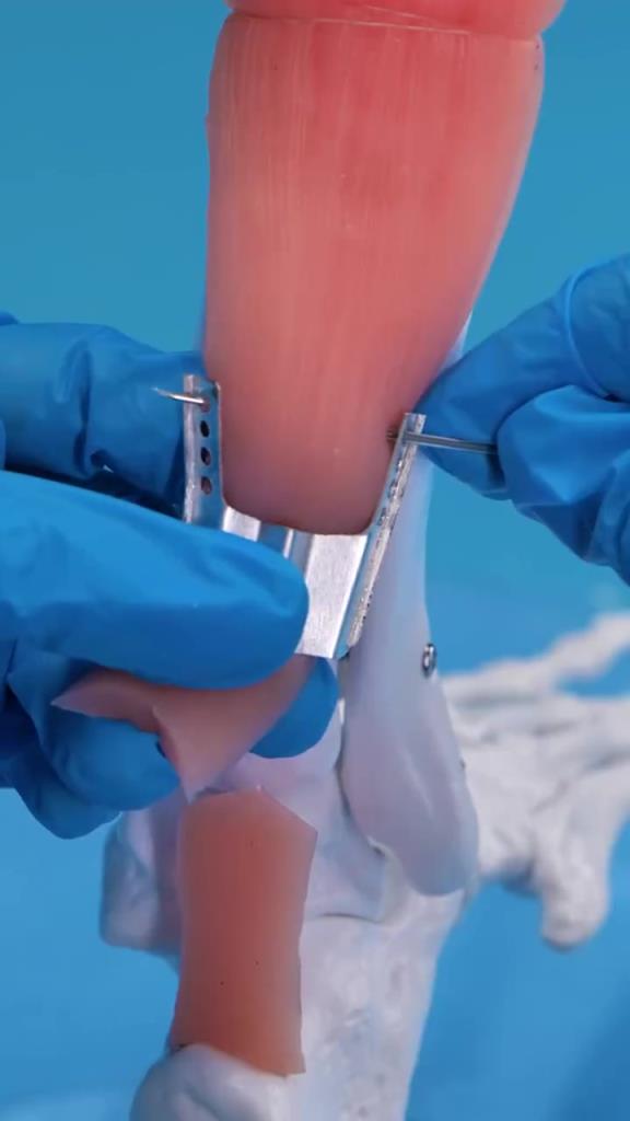 运动员们的跟腱都是怎么修复的？这么看起来真的太辛苦了