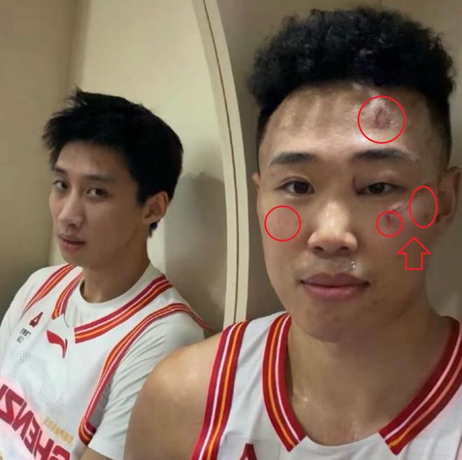 觸目驚心！打了一場CBA比賽，整張臉都被“毀容”了 球迷：可怕