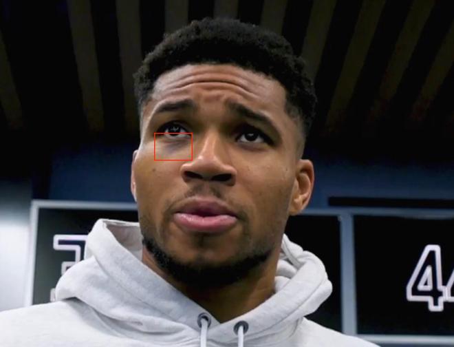 字母哥谈眼伤：在超市看见个抢劫的，抓劫匪时被他肘击了