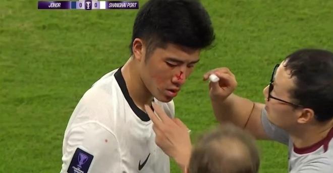 恶劣!海港名将亚冠遭对手鞋钉踩脸,主裁未掏红牌,名记:故意的