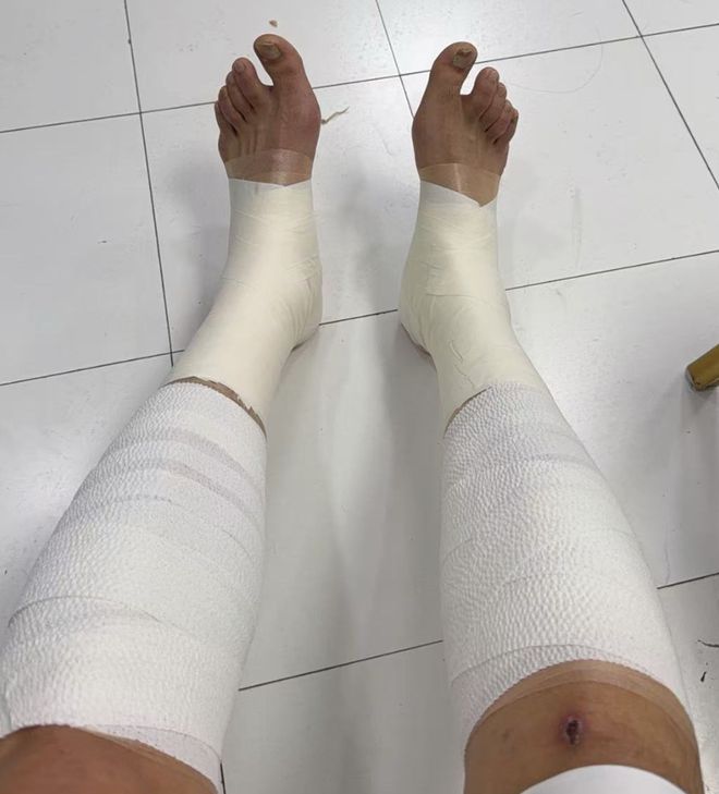 胜山西谁注意翟晓川赛后伤势？双腿拉伤绑满绷带，看着都残忍！